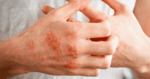 6 Common Eczema Triggers We Need To Know