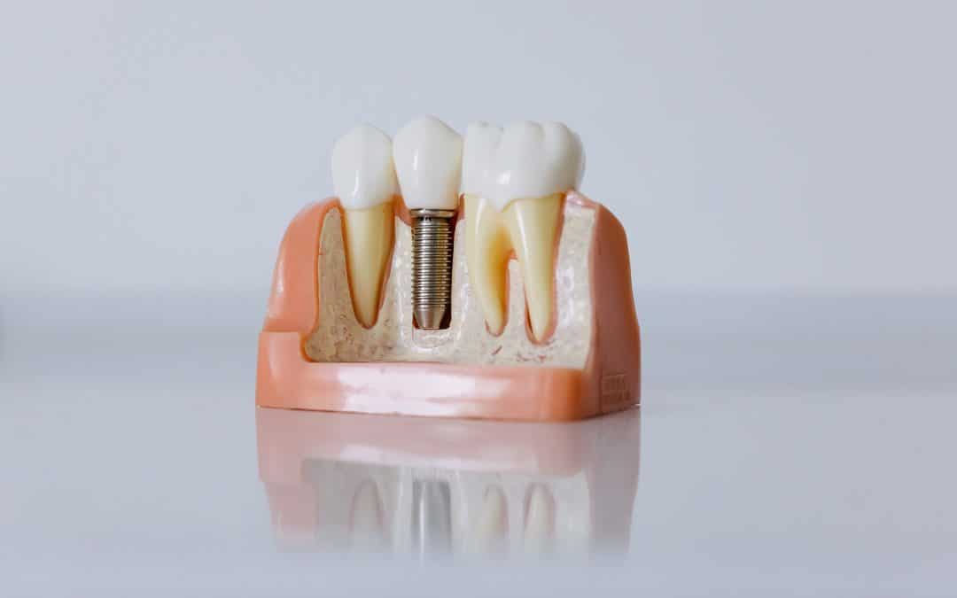 Dental Care and Implants: A Comprehensive Guide